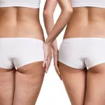 7 Modi per combattere la Cellulite in modo Naturale