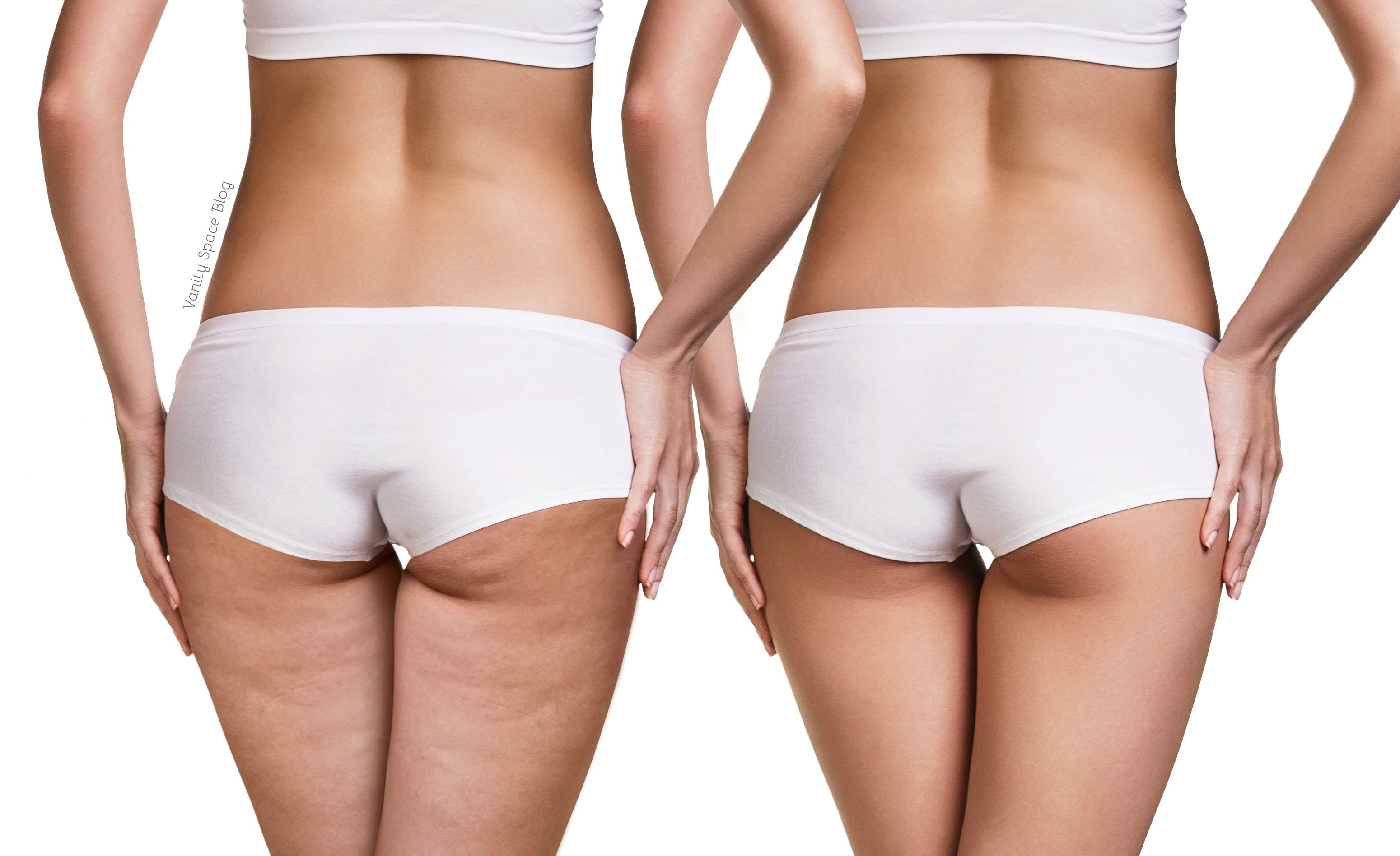 7 Modi per combattere la Cellulite in modo Naturale