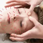 Curare il mal di testa con l'agopuntura