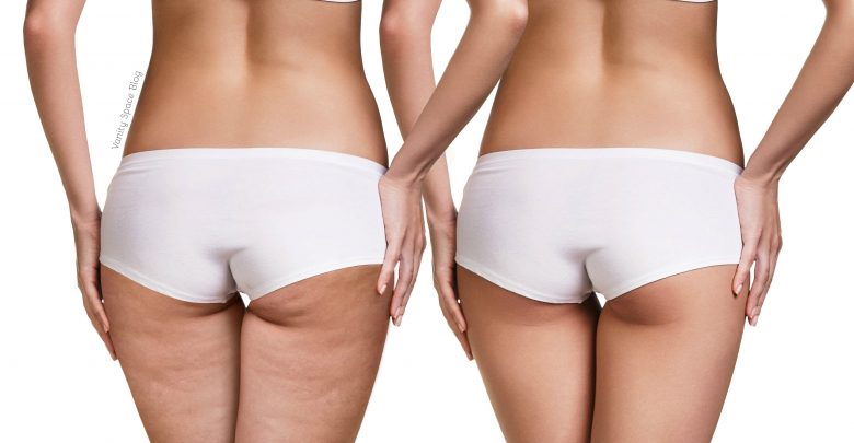 ridurre cellulite